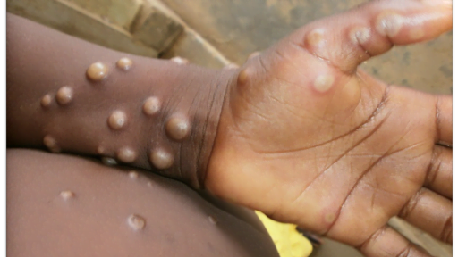 What Is Monkeypox, and How Worried Should Americans Be? 